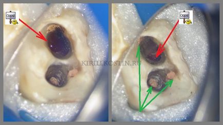 Retratarea canalelor dentare cu microscop în cazuri dificile, perfectsmile