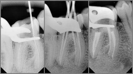 Retratarea canalelor dentare cu microscop în cazuri dificile, perfectsmile