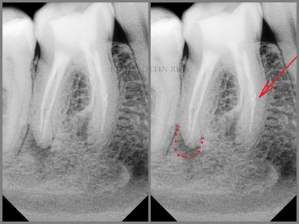 Retratarea canalelor dentare cu microscop în cazuri dificile, perfectsmile