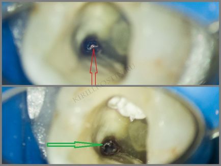 Retratarea canalelor dentare cu microscop în cazuri dificile, perfectsmile