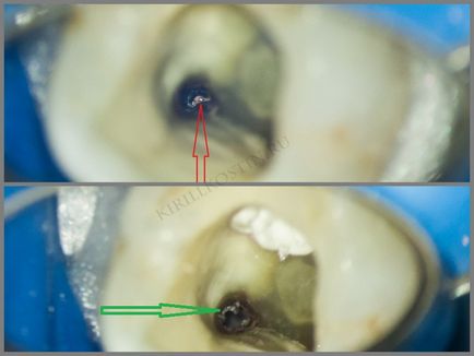 Переліковування каналів зуба з мікроскопом в складних випадках, perfectsmile