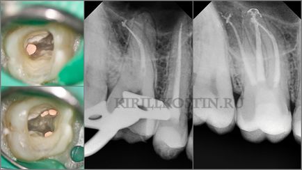 Retratarea canalelor dentare cu microscop în cazuri dificile, perfectsmile