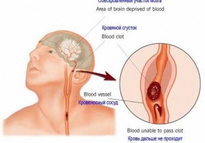 Primul ajutor medical pentru accident vascular cerebral și semnele sale principale