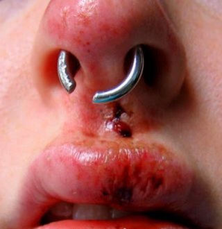 Septum piercing (septul nazal) - îngrijire, infecție, tratament, fotografie