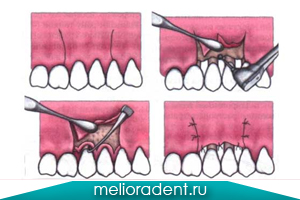 Gum plastica chirurgie în clinica dentară, prețul operațiunii