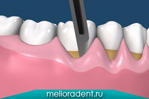 Пластика ясна в стоматологічній клініці, ціна операції