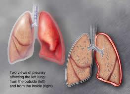 Mutație pleurodiafragmatică, boală pulmonară