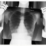 Mutație pleurodiafragmatică, boală pulmonară