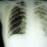 Плевродіафрагмальних зрощення, захворювання легенів