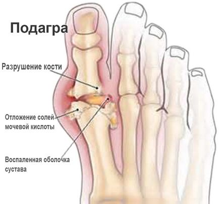 Gută - simptome, tratament în spital și acasă