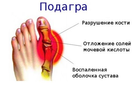 Подагра - симптоми, лікування в стаціонарі і домашніх умовах