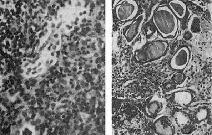 Gâtul rinichiului determină dezvoltarea patologiei