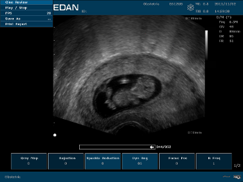 Scaner portabil cu ultrasunete edan u50