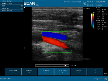 Hordozható ultrahang szkenner Edan U50