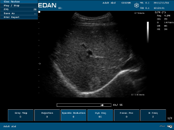 Scaner portabil cu ultrasunete edan u50