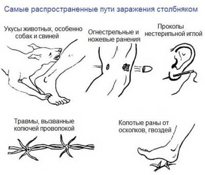 Причини і симптоми правця