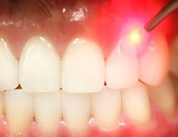 Примение лазера в стоматології