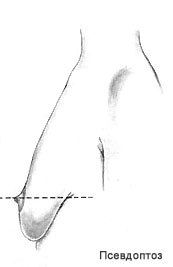 Птоз грудей причини, класифікація, способи самостійної діагностики