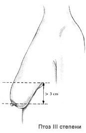Птоз грудей причини, класифікація, способи самостійної діагностики