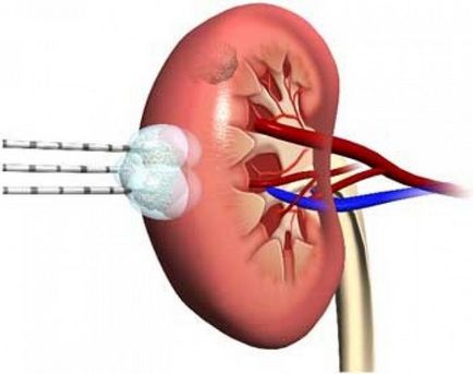 Metode de tratare a cancerului la rinichi