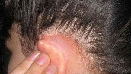 Себорейний дерматит волосистої частини голови лікування