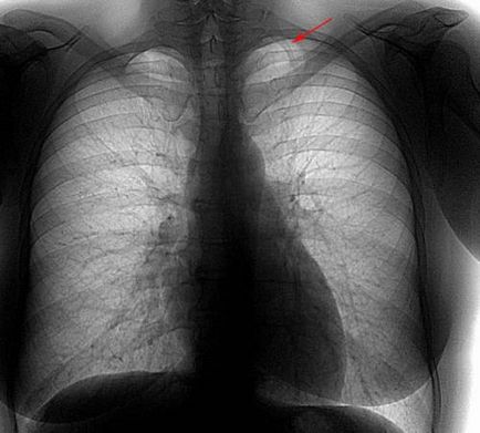 Ribul cervical al cauzei, diagnosticul, prevenirea