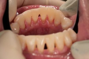Îmbinarea dinților după bretele