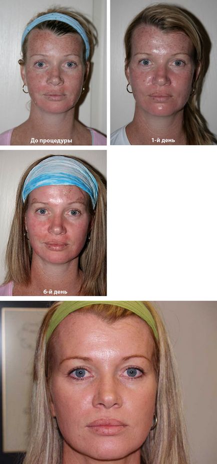 Шліфування шкіри вирівнюємо рельєф - косметичні процедури - матусі Сімферополя