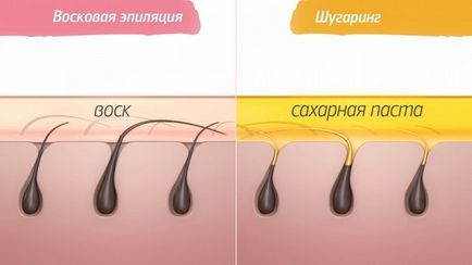 Шугарінг або віск що краще для видалення волосся