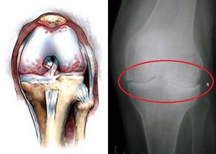 Tünetek arthrosis, betegség-kép, az első (kezdeti) megnyilvánulásának kezelésére, mint