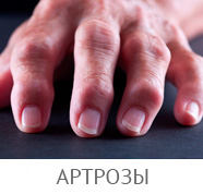 Simptomele artritei articulare, fotografiile simptomelor bolii, primele manifestări (inițiale) ale bolii, cum ar fi