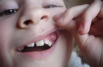 Simptomele și cauzele fluxului pe gingiile unui copil