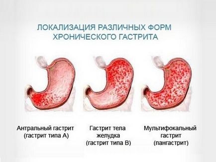 Simptome de exacerbare a gastritei