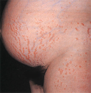 Erupții și mâncărime pe abdomen în timpul sarcinii
