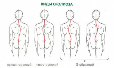 Scolioza coloanei vertebrale cervicale, simptome și tratament, exerciții