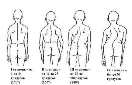 Scolioza coloanei vertebrale cervicale, simptome și tratament, exerciții