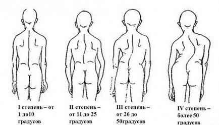 Scolioza coloanei vertebrale cervicale și simptomele