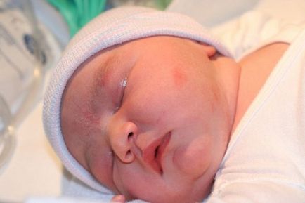 Pete vasculare la nou-născuți sau debut și metode de tratament