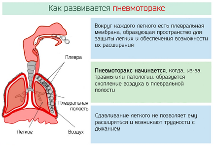 Simptome pneumotorax spontane, cauze și tratamentul colapsului pulmonar traumatic