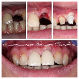 Стоматологія доктора Косневич - s photos in @dentistry_of_kosnevich instagram account