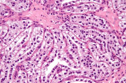 Eliminarea tratamentului cu rinichi de cancer celular, prognoza