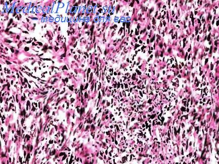 Carcinoide tipice și atipice ale plămânilor