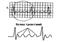 Тріпотіння передсердь - причини, симптоми, діагностика та лікування