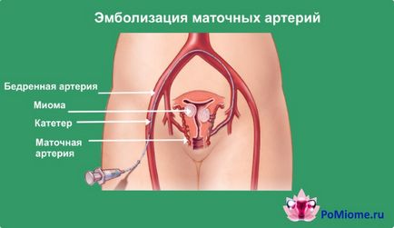 Eliminarea uterului cu efecte miomologice, recenzii, tipuri de operații