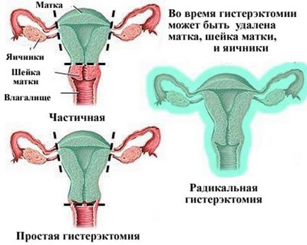 Eliminarea uterului cu efecte miomologice, recenzii, tipuri de operații