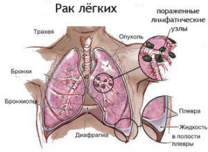 Eliminarea unei tumori pulmonare