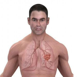 Eliminarea unei tumori pulmonare