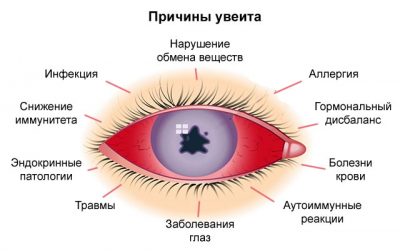 Uveitis szem tünetek és a kezelés, mi az, az oka a