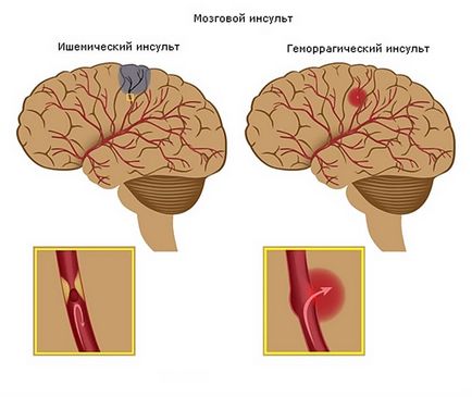 Венотоникі при порушенні венозного відтоку головного мозку