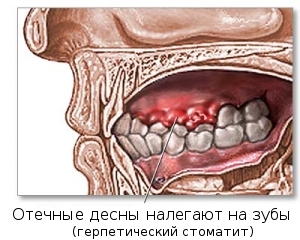 Види стоматиту у дітей і дорослих фото і опис